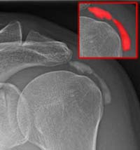 Frozen shoulder
